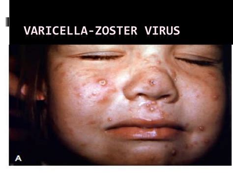 PPT - Varicella -zoster virus PowerPoint Presentation, free download - ID:4168209