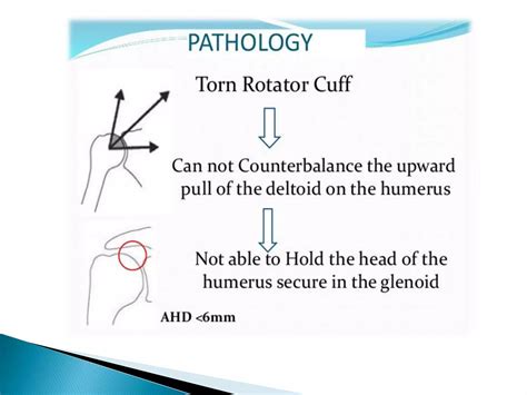 Pathophysiology of shoulder rotator cuff instability and repair | PPT