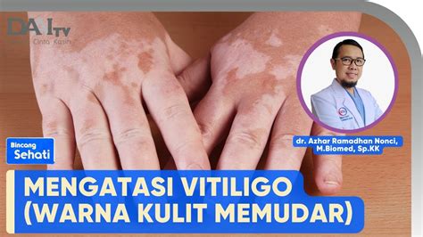 Mengatasi Vitiligo Bincang Sehati Youtube