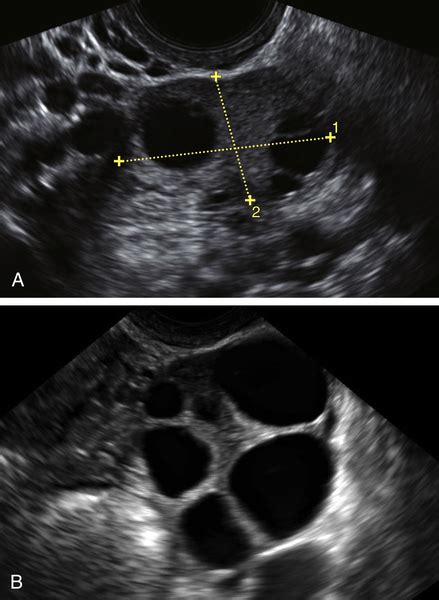 Normal Uterus Transvaginal Ultrasound