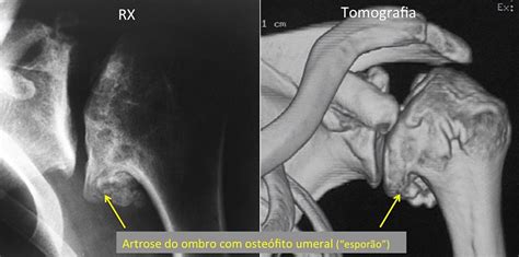 Artrose Do Ombro Dr Guilherme Franco