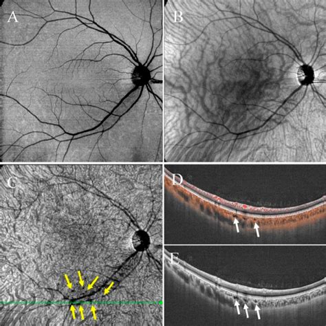 Multimodal Images Of Right Eye Of A 34 Year Old Woman Diagnosed With