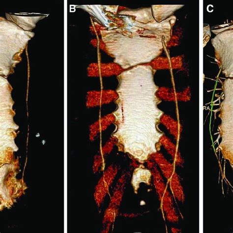 Three Dimensional Reconstitution Of Preoperative Chest Cta