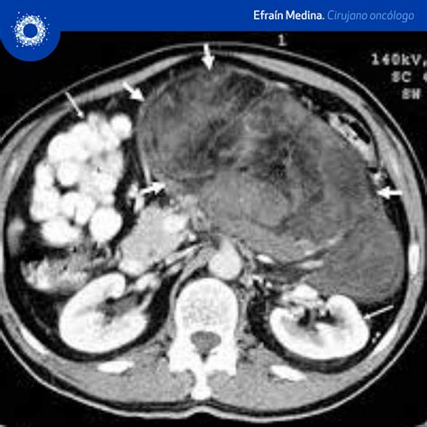 Sarcomas Retroperitoneales Cancer Y Oncología Medina