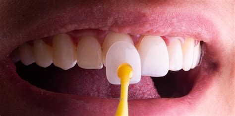 A Faceta Dental Pode Substituir O Aparelho Ortod Ntico Gou