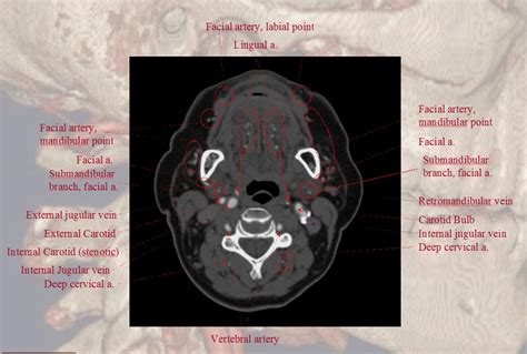 Ct Angio Atlas