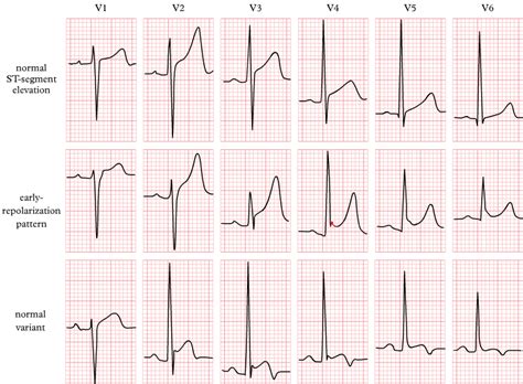 Myocardial Ischemia And Infarction Ekg Essentials A Student Handbook