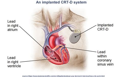 Cardiac Resynchronization Therapy Crt Devices