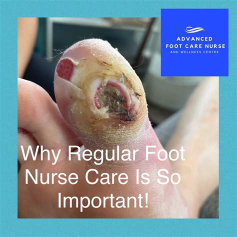 Why Regular Foot Nurse Care Is So Important