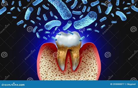 Bacterial Tooth Infection stock illustration. Illustration of hygiene