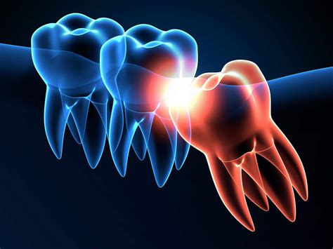 Can Wisdom Teeth Cause Migraines? - Find Neurologists Near Me