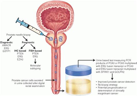 New Molecular Markers Of Diagnosis And Prognosis In Prostate Cancer Basicmedical Key