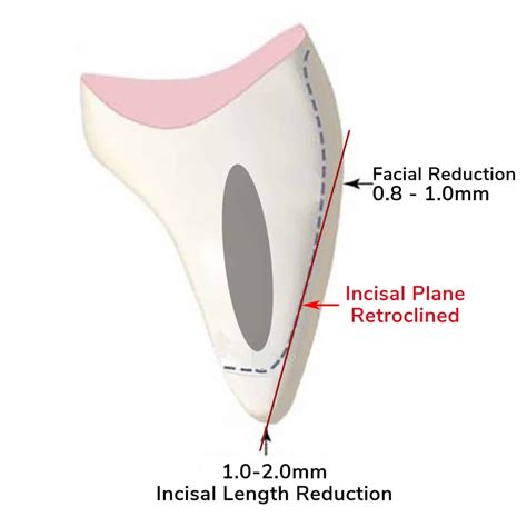 Prepping For Porcelain Veneers Should Be Dependent On The Individual