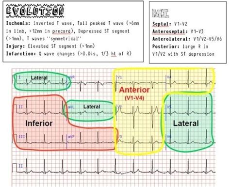 Printable 12 Lead Ekg Interpretation Cheat Sheet Handy Printable Materials