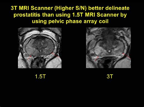 Figure 6 From Multi Parametric Mri Mp Mri In Prostate Experience And