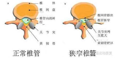 椎管狭窄及其机制 知乎