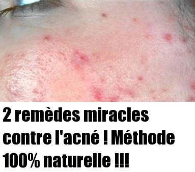 Rem Des Miracles Contre L Acn M Thode Naturelle Sant