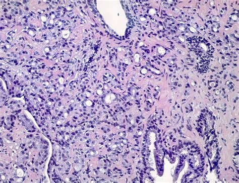 Pathology Outlines P