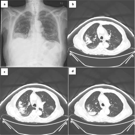 A Chest X Ray Image Of Pneumonic Consolidation At The Base Of The