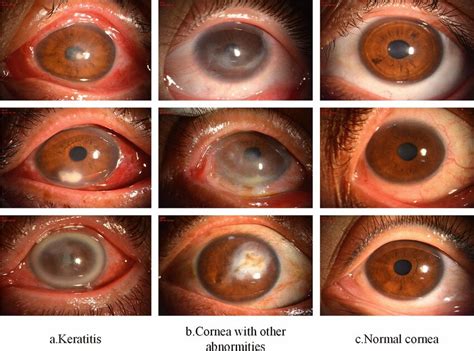 Several Representative Corneal Slit Lamp Images A Images Of