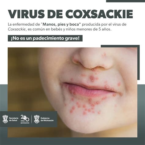 Conoce C Mo Prevenir El Virus Coxsackie Que Afecta A Menores De A Os