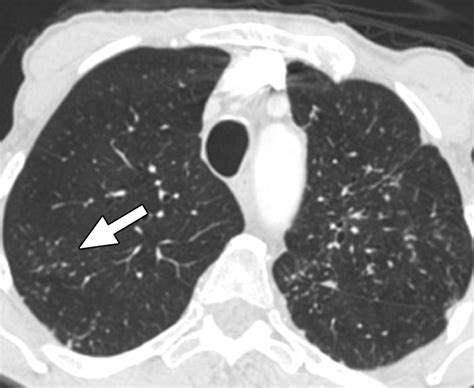 Diffuse Pulmonary Nodules Ajr