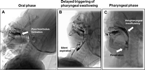 Evaluation Of Feeding Difficulties Using Videofluoroscopic Swallow