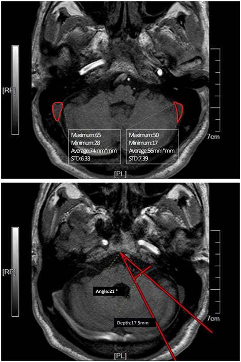 Frontiers | Surgical anatomy of sigmoid sinus with evaluation of its ...