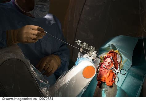 Reportage In The Stereotactic Neurosurgery Operating Theatre In Pasteur