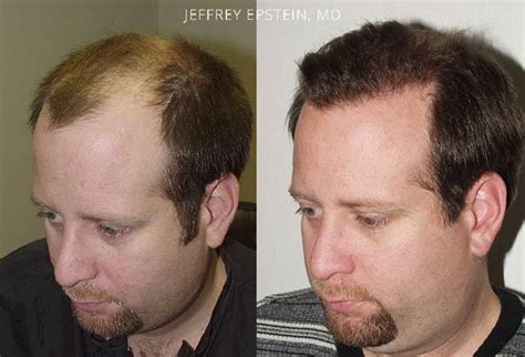 Hair Transplants For Men Photos Miami Fl Patient38516