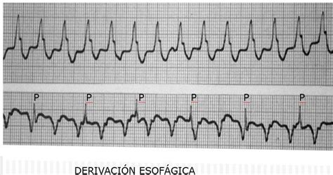 Paciente que presenta taquicardia regular de QRS ancho en quién se