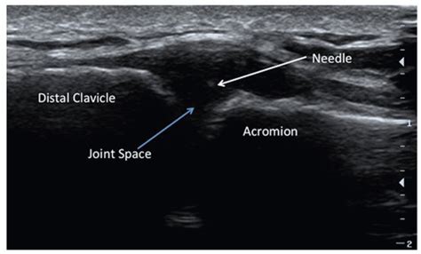 Ultrasound Guided Injection Of The Acromioclavicular Joint Anesthesia Key