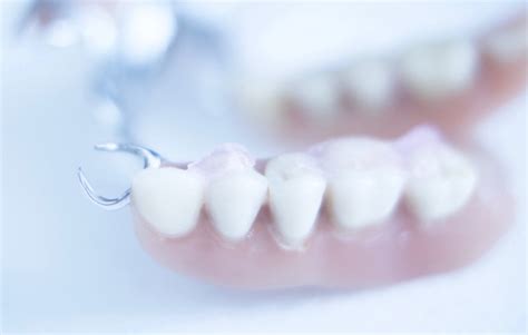 Dentures and Other Options - What Are the Alternatives?