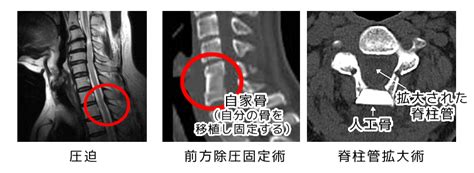 脊髄症（頚髄症）・頚椎症性 神経根症の治療・手術について 春陽会中央病院 鹿児島県の整形外科・人工関節・ヘルニア・狭窄症・変形性関節症