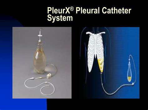 Pleural Effusion Catheter