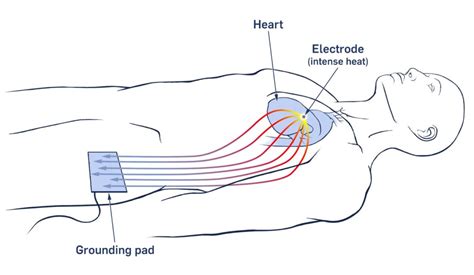 Surgical Treatment Of Atrial Fibrillation A Kyu Design