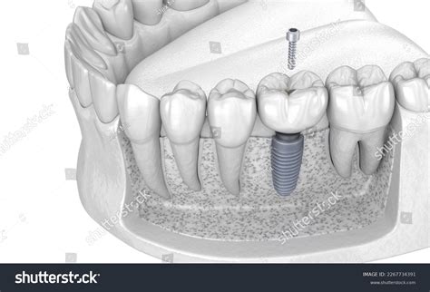 Dental Crown Installation Over Implant Abutment Stock Illustration 2267734391 | Shutterstock