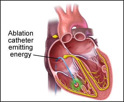 Ventricular Tachycardia Ablation