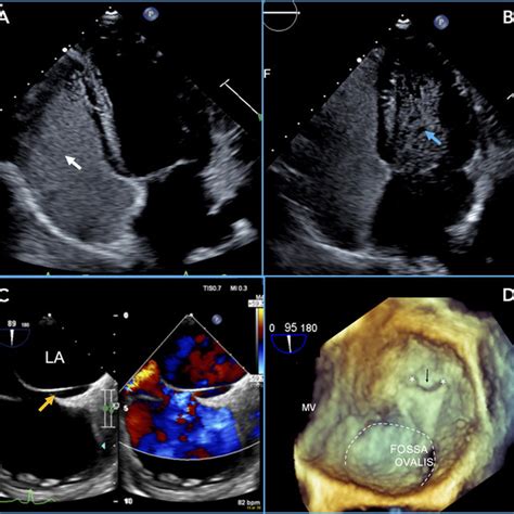 Pdf Patent Foramen Ovale Closure State Of The Art