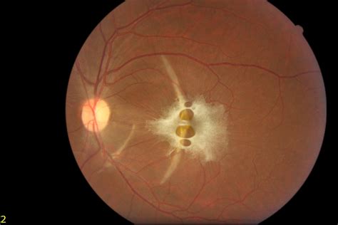 Traumatic Epiretinal Membrane With Double Choroidal Rupture 1 1