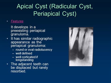 Periapical Granuloma Vs Cyst