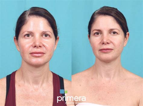 Cynosure Icon® Ipl Before And After Photo Gallery Orlando And Tampa