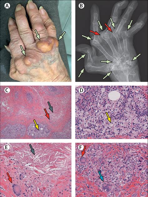 Rheumatoid Arthritis Nodules