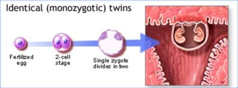 Clin Med OB Multiple Gestation Flashcards Quizlet