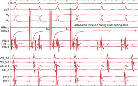 AV Nodal Reentrant Tachycardia Atypical Basicmedical Key