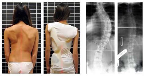 La Scoliosi Idiopatica Giomi Strutture Ospedaliere