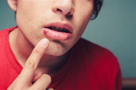 The Top 5 Otc Cold Sore Treatments Compared