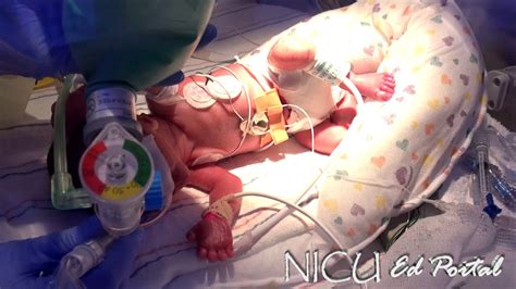 Surfactant Premature Babies Treatment