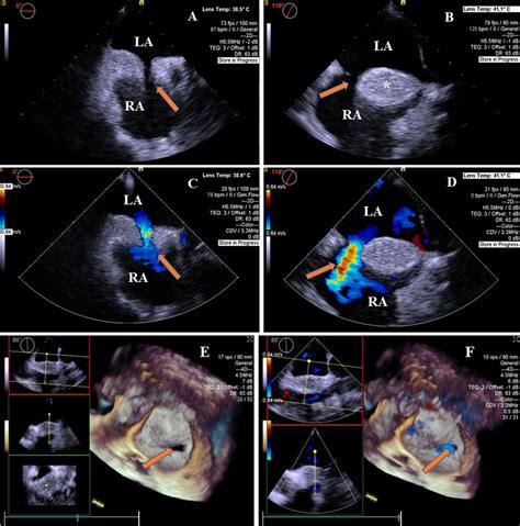 Frontiers Multimodality Imaging In Diagnosing Lipomatous Atrial Septal Hypertrophy With Atrial