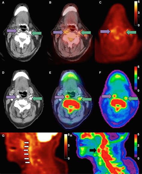 Dual Tracer Positron Emission Tomography For Identification Of Culprit